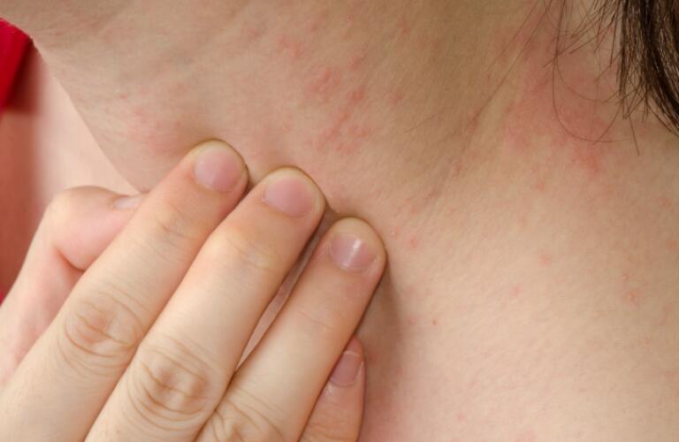 ATOPIC DERMATITIS