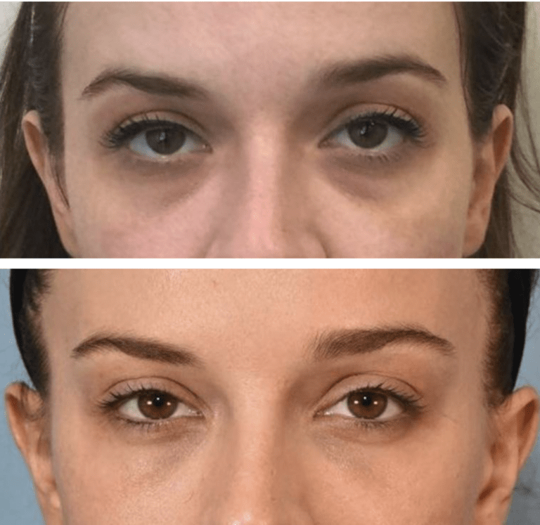 UNDER EYE FILLER BEFORE AND AFTER