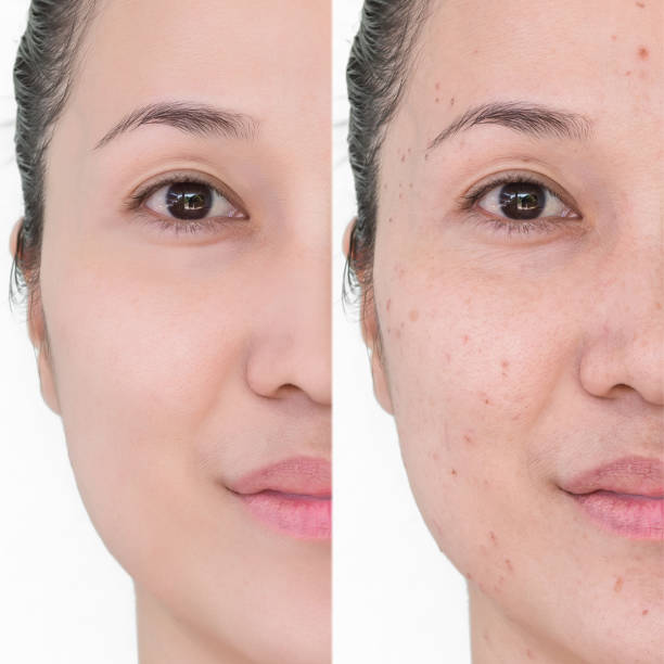 Tretinoin Microsphere Gel  Treatment of Anti aging and reduces