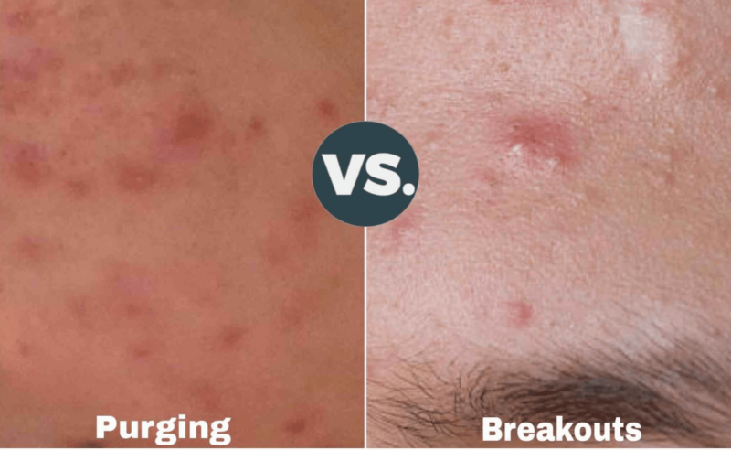 Tretinoin Before And After Acne