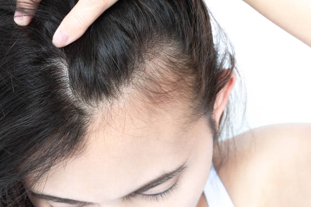 postpartum hair loss