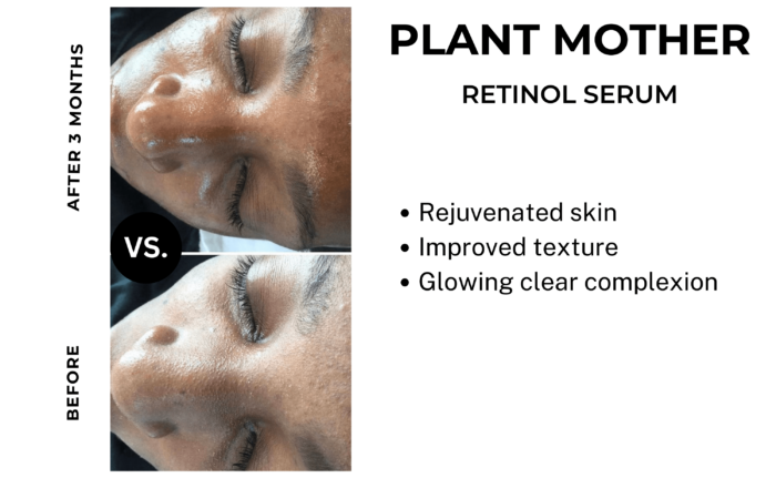 retinol serum before and after_3m