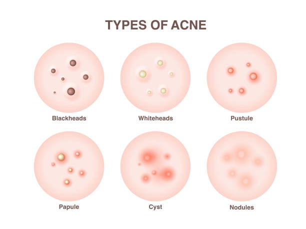 types of hormonal acne